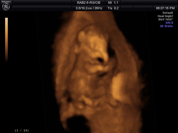 Elephant in utero