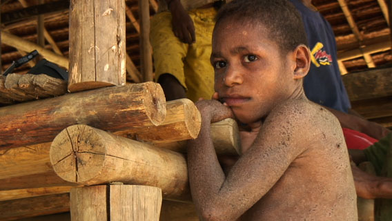 Boy at Pai Pai: some of the most tragic victims of the logging crisis in Papua New Guinea are the next generation. Photo by: David Fedele.